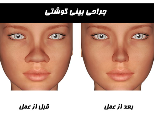 Surgical nose in Iran