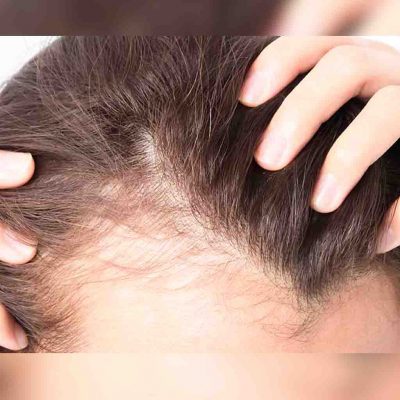 Hair loss and its causes
