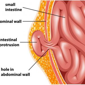 Repair of abdominal hernia