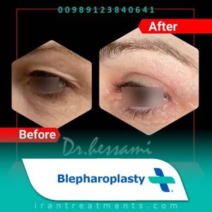 Blepharoplasty in Iran