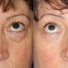 Cosmetic eyelid surgery