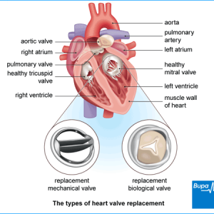Cardiac valve replacement surgery