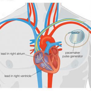 Permanent pacemaker implantation