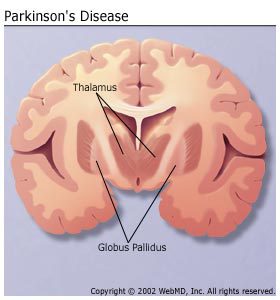 Parkinson's surgery