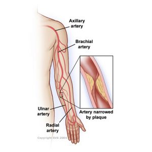 Vascular repair of any additional
