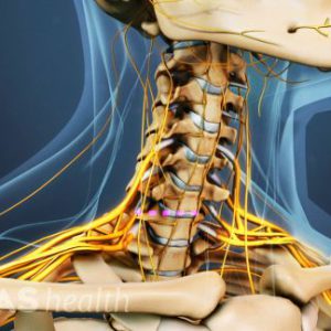 Surgery of narrowing of the spinal cord