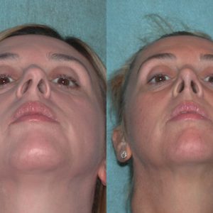Nose deflection surgery