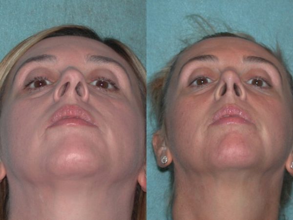 Nose deflection surgery