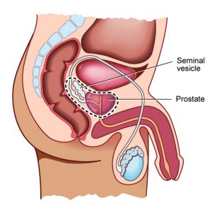 Prostatectomy