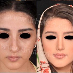 Nose surgery in Iran