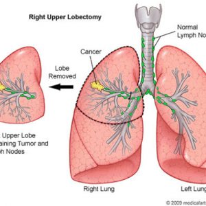Lung tumor surgery