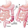 Colectomy