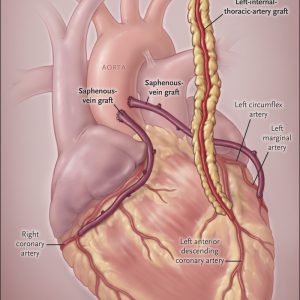 coronary artery bypass surgery