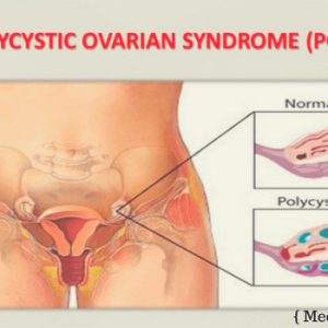 Surgery of Ovarian Cyst