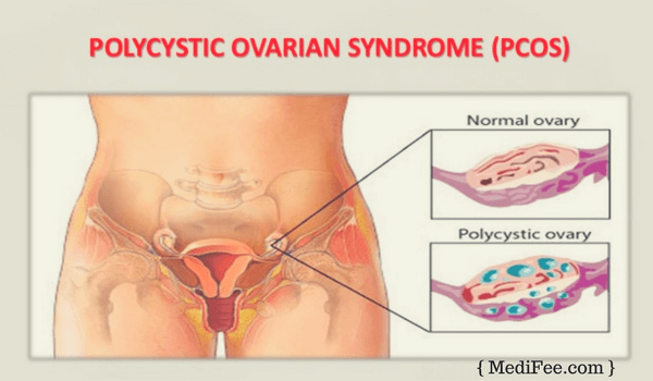 Surgery of Ovarian Cyst