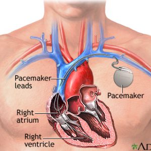Pacemaker insection