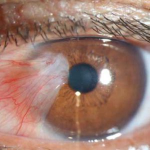 pterygium with graft in iran