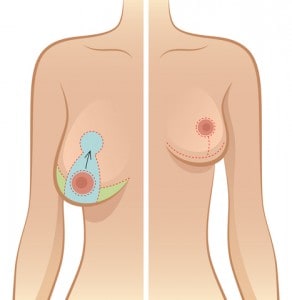 Mastopexy Surgery (Breast Lift), India- Surgery and Cost