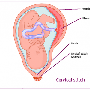 Cervical Cerclage
