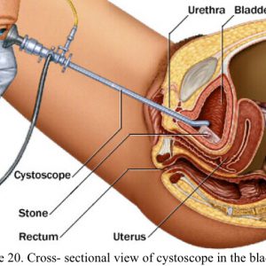Cystoscopy