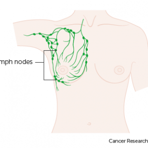 Lymph nodes biopsy