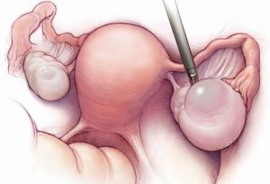 Overian cyst operation
