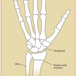 Wrist Fracture