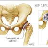 Total hip artroplasty