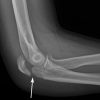 Elbow fracture