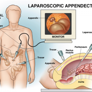 Laparoscopic Appendectomy