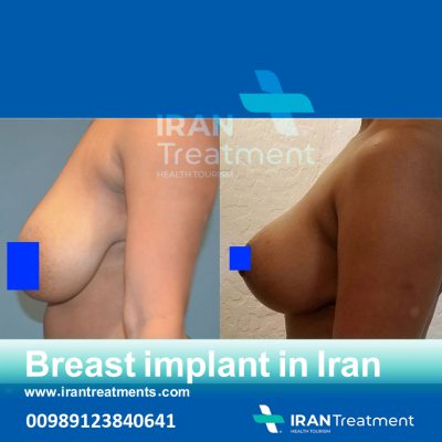 breast implant in iran