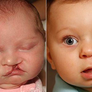 lip cleft surgery in Iran