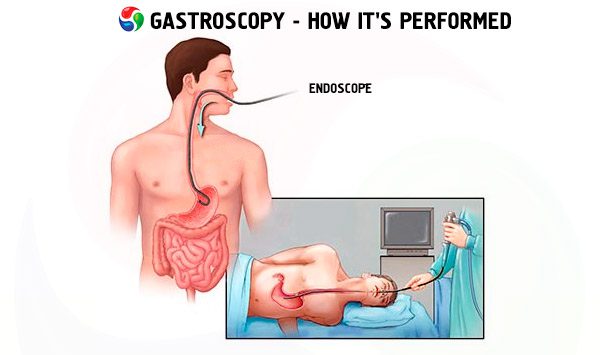 Upper GI endoscopy