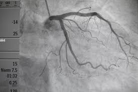 Coronary Angiography