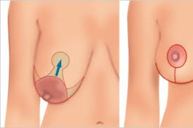 Breast lift by Dr. Arjang Ghahremani