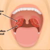 Tonsilectomy