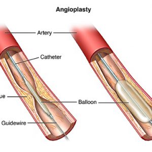 Angioplasty (one vessel) (without balloon-stent)