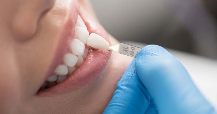 dental laminate in Iran