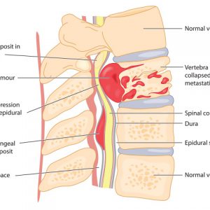 Spinal cord tumor