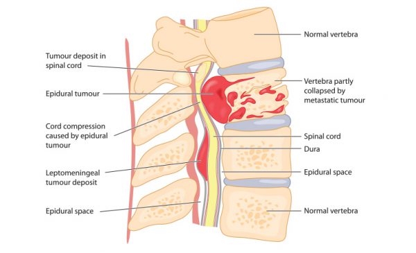 Spinal cord tumor