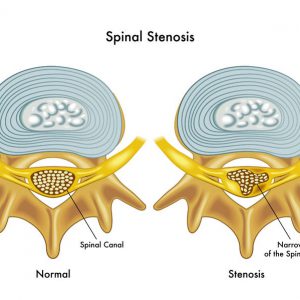 Canal Stenosis
