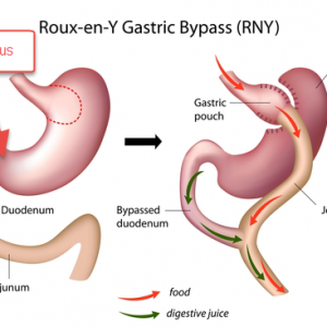gastric bypass surgery in Iran