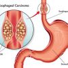Esophageal Cancer Surgery in Iran