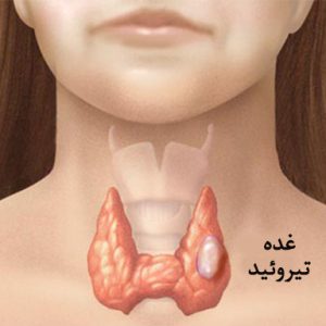 Thyroid cancer Surgery in Iran