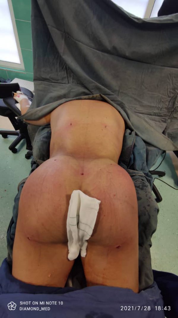Brazilian Butt Lift in Iran | PAL liposuction and fat transfer to buttocks Dr. Reza Hessami