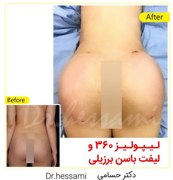 Brazilian Butt Lift in Iran