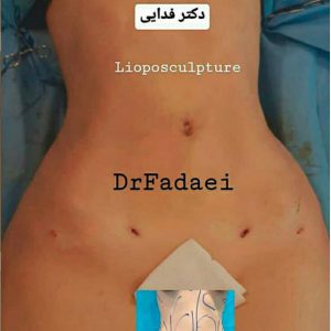 Liposuction abdominal fat and rib - fat injection in the but