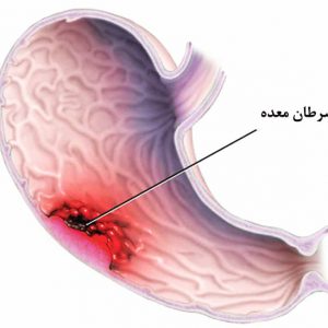 Gastric cancer Surgery in Iran
