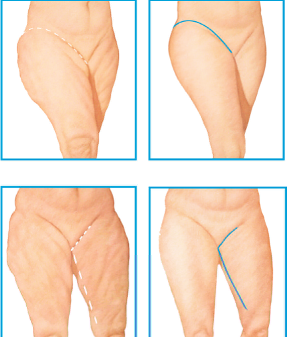 Thigh slimming cosmetic surgery in Iran