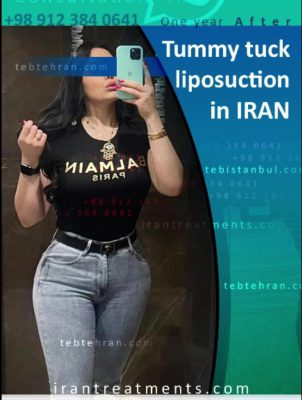 Tummy Tuck in Iran
